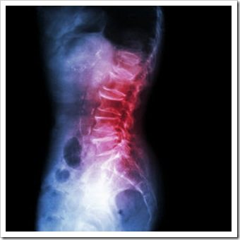 Back Pain Somerset NJ Arthritis