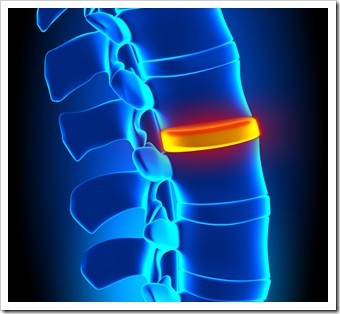 Herniated Disc and Back Pain Somerset NJ