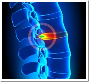 Back Pain Somerset NJ Spinal Decompression