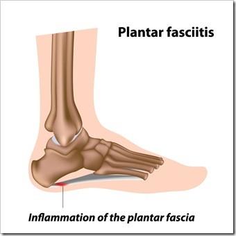 Foot Pain Somerset NJ Plantar Fasciitis