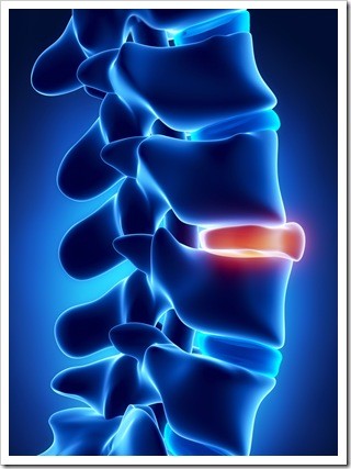 Slipped Disc Somerset NJ