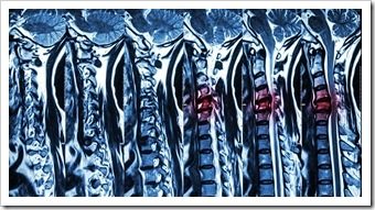Back Pain Rehab Somerset NJ Spinal Surgery
